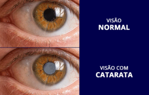 catarata