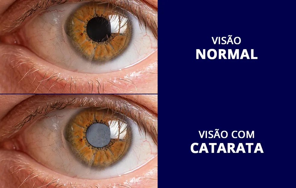 catarata
